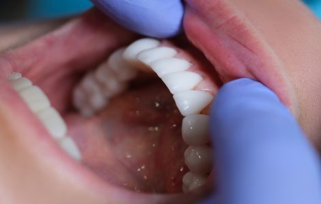 Unlock Your True Smile Potential: Unveiling the Power of Dental Veneers!