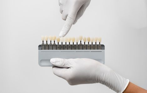 Are Veneers Permanent? What You Should Know Before Deciding