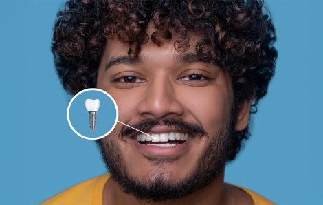 Why Dental Implants Are Considered the Gold Standard for Tooth Replacement